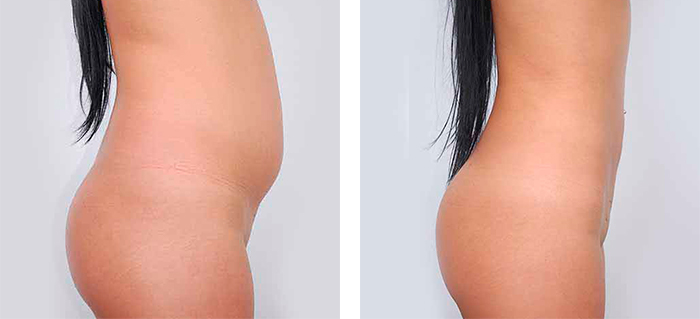 Liposuction before-after