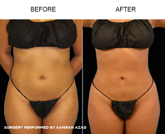 liposuction13-1