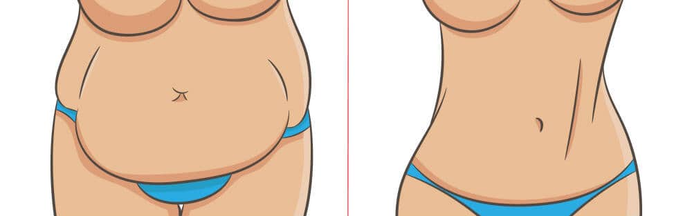 Liposuction vs. Tummy Tuck