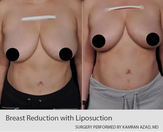 breast liposuction