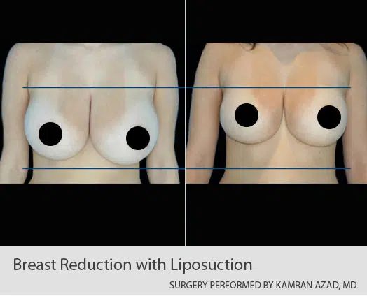 Breast reduction with liposuction