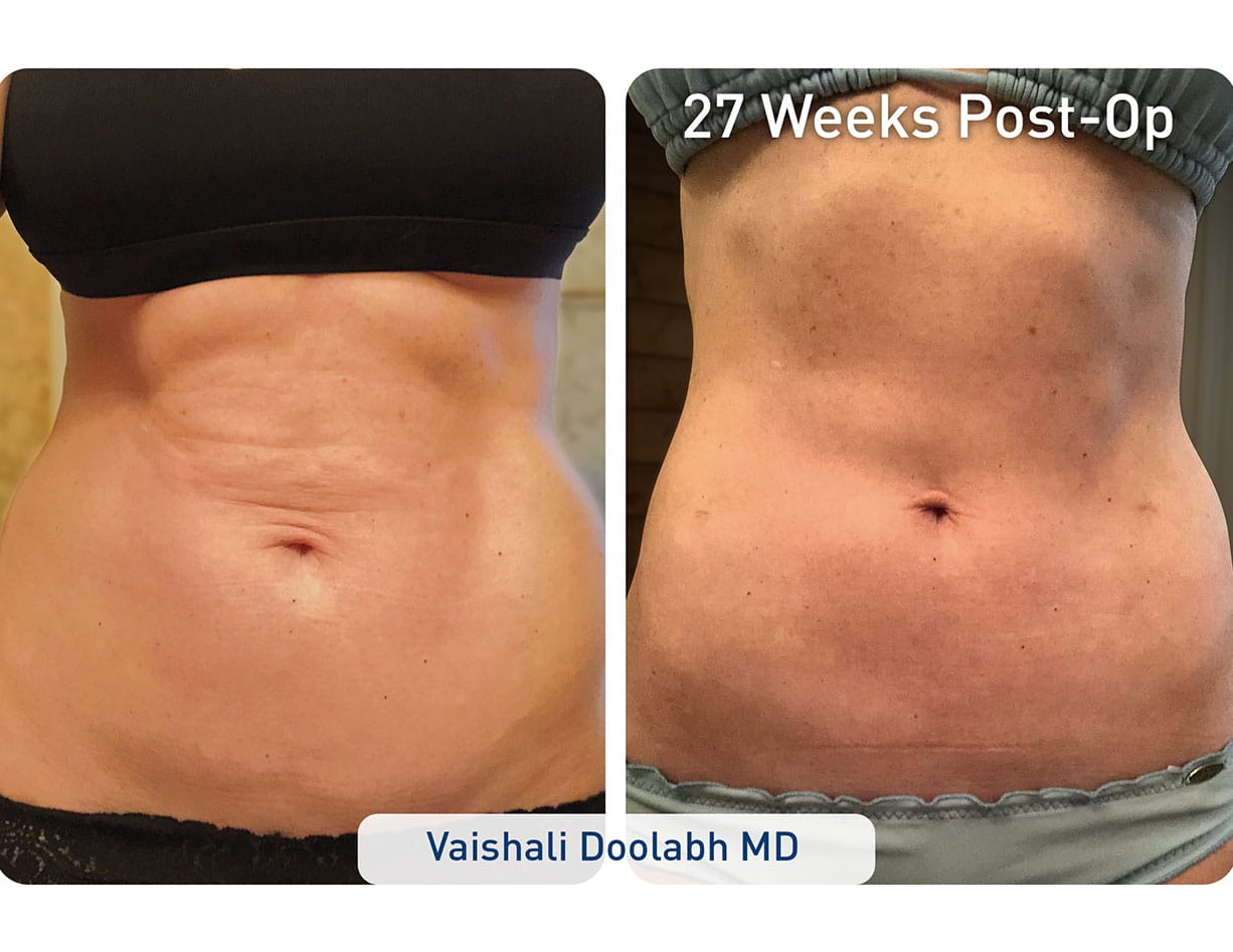 Miracle Skin Tightening® Recovery