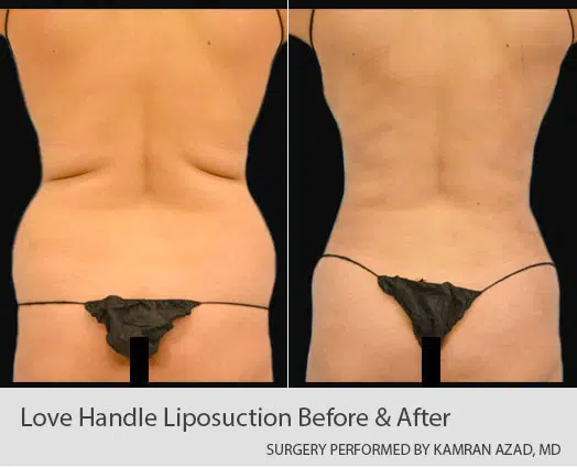 love handle liposuction