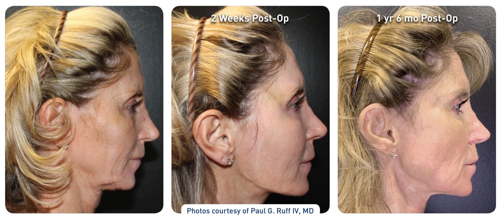 Miracle Skin Tightening®