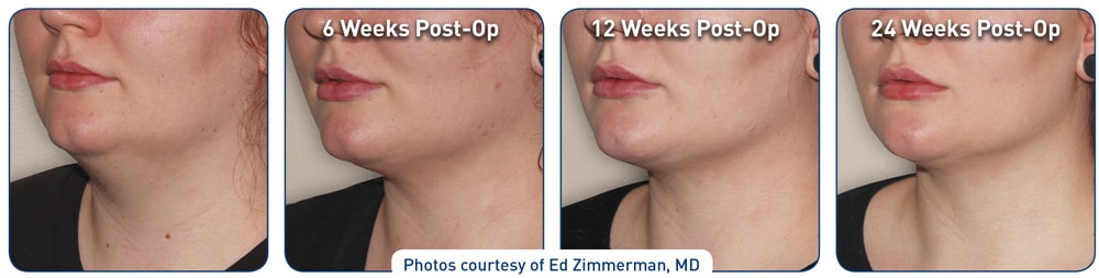 Miracle Skin Tightening®