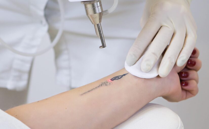 Surgical Tattoo Removal: Experience the Cheapest Technique for Complete Removal with Centre for Surgery! 1 1698771635
