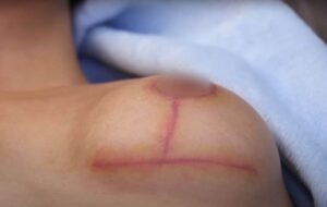 Breast Implant Removal for Medical Reasons: Navigating Health Concerns 2 Breast Reduction Scars 768x487 1