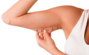 arm lift surgery remove excess skin
