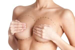 Breast Augmentation Unveiled: Addressing Common Boob Job FAQs 1 breast lifteditted