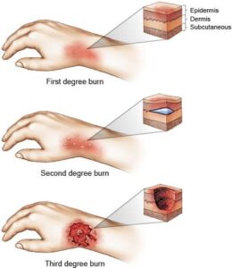 burn treatment