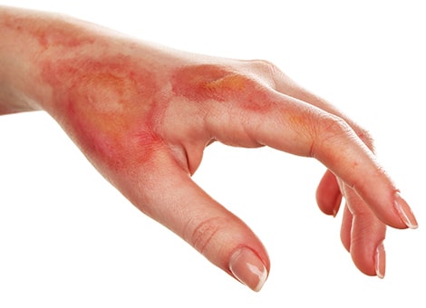 post burn surgery services 1592829457 5491613