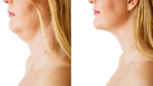 Kybella vs. Liposuction: Choosing the Right Double Chin Solution 2 What is a neck lift