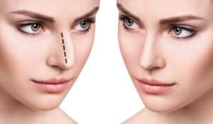 The Evolution of Nasal Aesthetics: Non-Surgical Rhinoplasty Innovations 2 rhinoplasty before and after