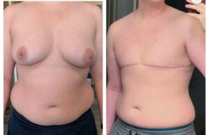 From Transition to Transformation: The Role of Chest Masculinization Surgery 2 non binary top surgery