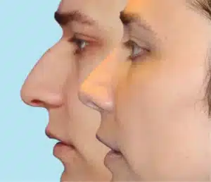 nose feminization