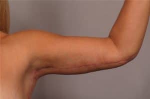 Arm Lift Surgery Scars: Top Strategies for Smooth Healing 3 30693 91437a AM