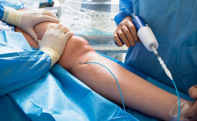 Venaseal Procedure Cost: Insurance Insights & Treatment Expenses 1 60f5d2524ede613fef9215c9 Varicose Veins Treatment FAQs About VenaSeal MAIN