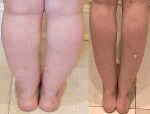 BA CALFANKLE LIPO 02.26.2019 1